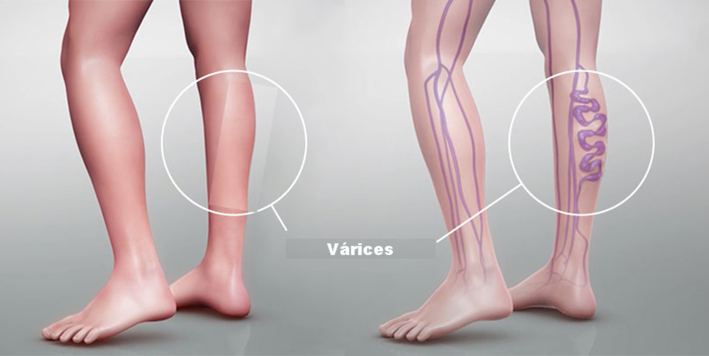 Clínica de Varices (Dr. Martín Vázquez)